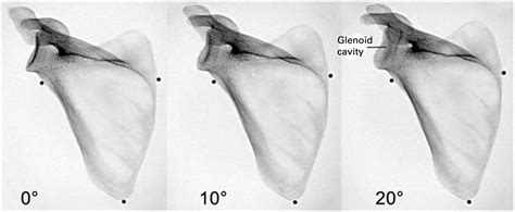 The Assessment Of Scapular Radiographs Bone Joint