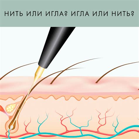 Электроэпиляция нитью — особенности, отзывы - Продвинутый курс по ...