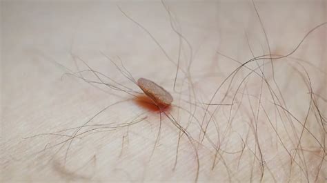 Cancerous Skin Tags: Pictures and When to See a Doctor in 2022 | Skin ...