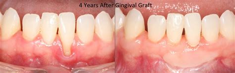 Gum Grafting Can Improve Your Oral Health Heres How Britten Perio