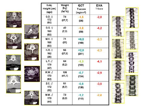 Quantitative Computed Tomography Versus Dxa Of The Lumbar Spine In