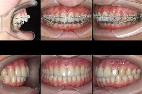 Correction Of Class Ii Malocclusion Corrective Jaw Surgery Dr Antipov