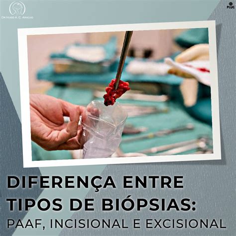 Diferenças entre tipos de Biópsias PAAF Incisional e Excisional