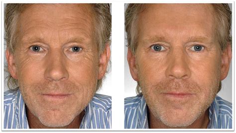 Botox Frown Lines Before And After