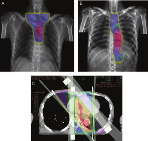 An Example Of The Radiotherapy Target Volume And Dose Distribution The