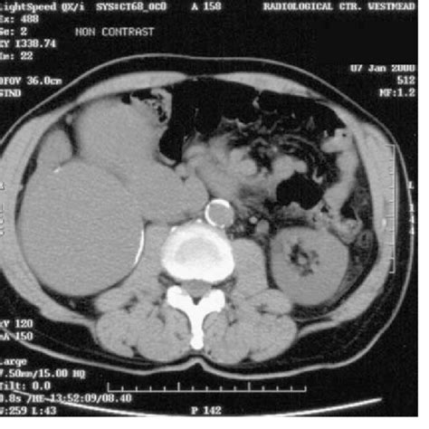 Non Contrast Ct Demonstrates Several Cyst Like Lesions With Download Scientific Diagram