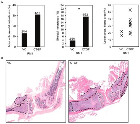 Increased Expression Levels Of Ctgf Promotes Bone Metastasis In Primary