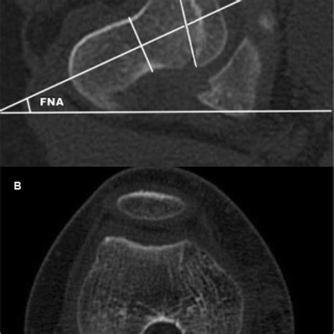 fna  ct image   femoral head   femoral neck  center