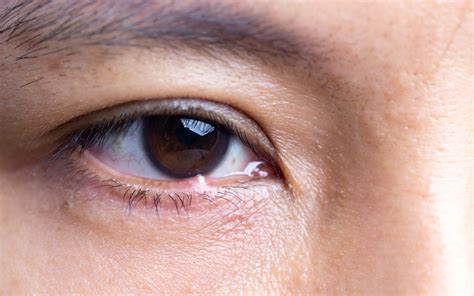 Chalazion And Stye Treatment Specialist Eduardo Besser Md