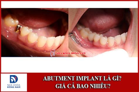 Abutment Implant Là Gì Giá Cả Bao Nhiêu