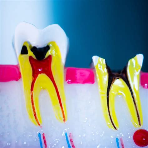 Don't Ignore These 4 Red Flags Of A Root Canal Infection