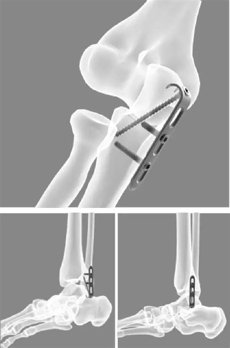 Titanium Locking Plate In Distal Humerus For Elbow With CE Certificate