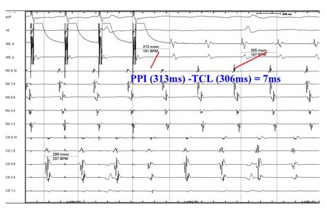 Atrial Flutter Diagnosis Management And Treatment IntechOpen