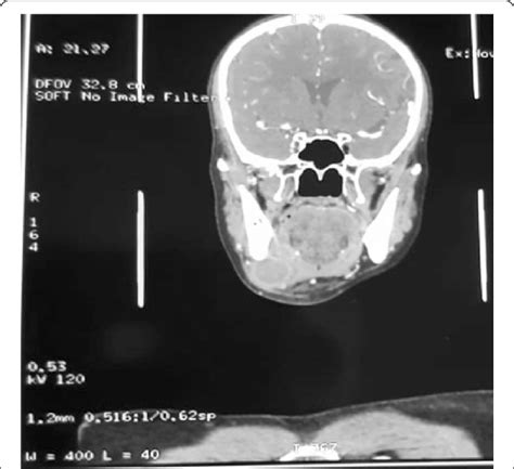 Preoperative CT scan outlining a mass in the submandibular area ...