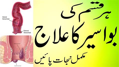 Bawaseer Ka Ilaj Hemorrhoid Piles Treatment Health Tips In Urdu