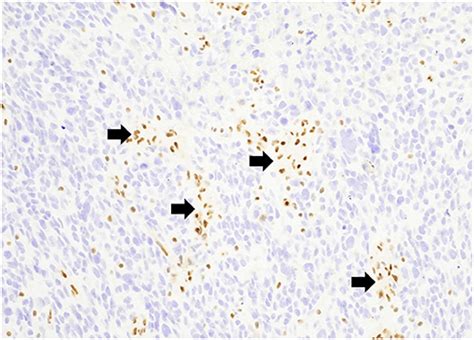 Frontiers Advanced Magnetic Resonance Imaging In Pediatric Glioblastomas