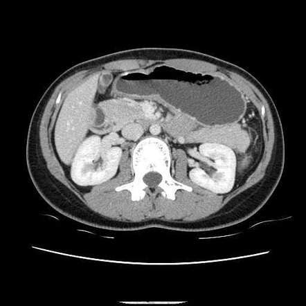 Viewing Playlist Abdomen Duodenum Radiopaedia Org