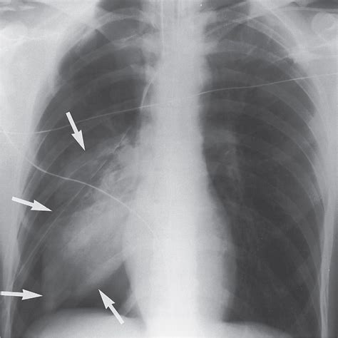 Signs And Patterns Of Lung Disease Radiology Key