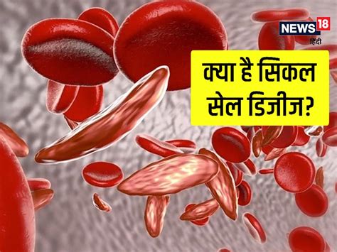 World Sickle Cell Day 2022 क्या है सिकल सेल डिजीज जानें इस बीमारी के