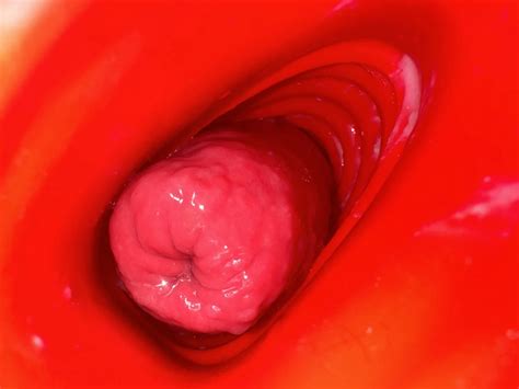 Anal Prolapse In Oxball Ff Pighole Nude Pics Xhamster