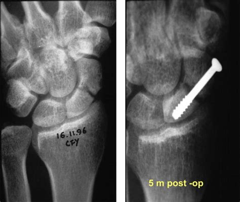 Minimal Invasive Management Of Scaphoid Fractures From Fresh To