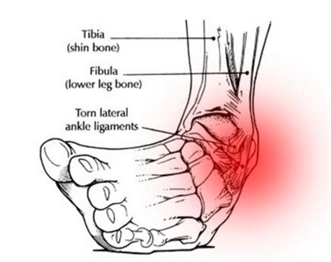 Ankle Sprain Causes Treatment And Prevention Reliva Physiotherapy