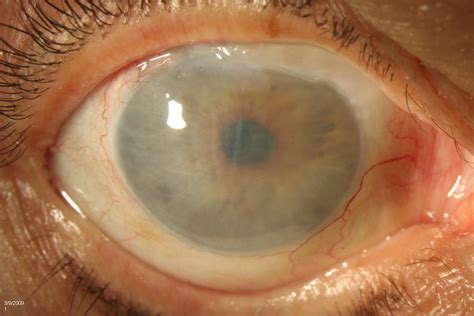 Edema Corneal