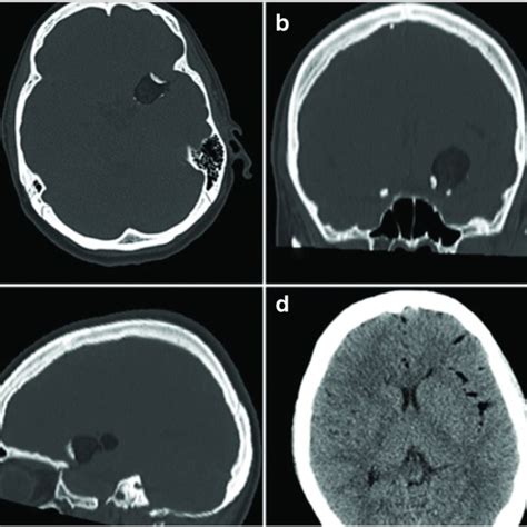 Headache In Ruptured Intracranial Dermoid Cysts