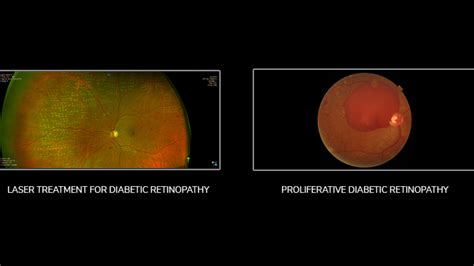 Diabetic Retinopathy Laser Treatment Recovery Time Lockheart Grieshaber