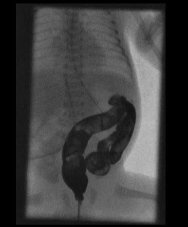 Meconium plug syndrome | Radiology Case | Radiopaedia.org