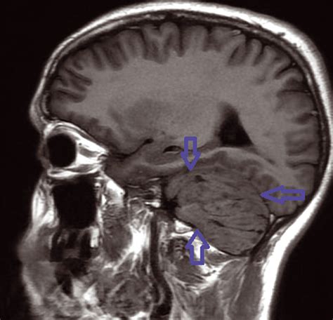 Left Mass Cerebellum In T1 Weighted Sequence Mri Download Scientific