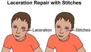 Laceration Repair With Stitches Discharge Instructions | Patient ...