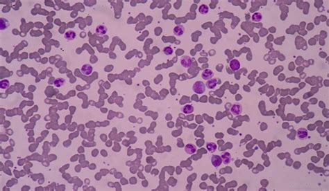 Leukocytosis: What Is, Types, Causes, Diagnosis, and Symptoms