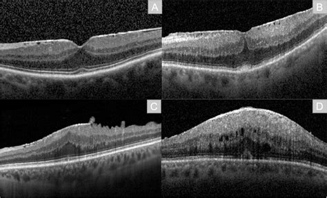 Staging Of Epiretinal Membranes Erm According To Govetto Et Al A Download Scientific