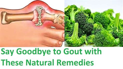 Say Goodbye To Gout With These Natural Remedies Youtube