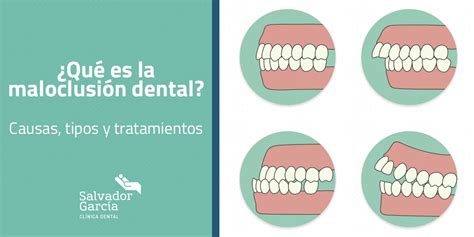 ¿qué Es La Maloclusión Dental Clinica Dental Salvador García Blog