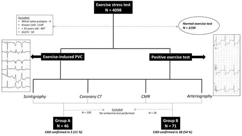 Premature Ventricular Contraction Wikipedia 9