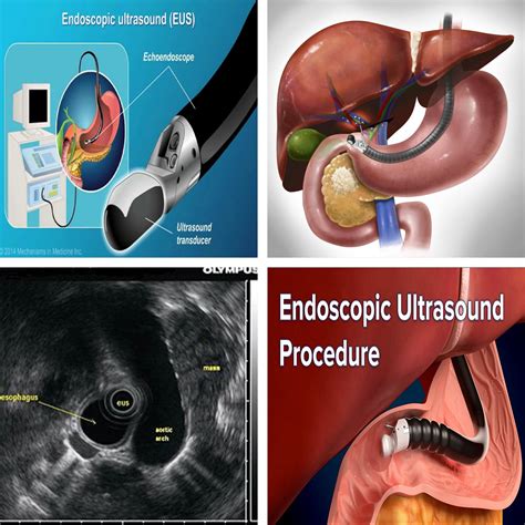 Endoscopic Ultrasound - ayushmancinics