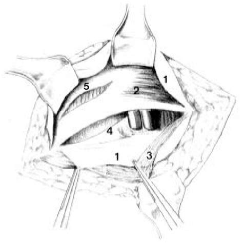 Inguinal Hernioplasty According To Lotheissen And Mcvay By Preparation