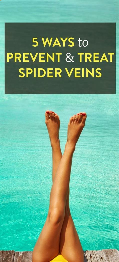 5 Ways To Prevent And Treat Spider Veins ~ Medibrisky