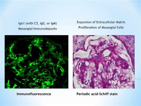 IgA Nephropathy