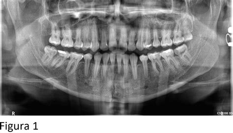 Caso Nº 29 Fractura Mandibular Radiodontica