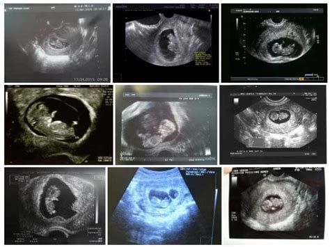 Semana 10 De Embarazo Síntomas Cuidados Panza Y Ecografía