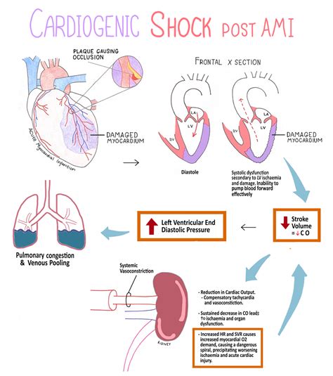 Mechanism Of Cardiogenic Shock