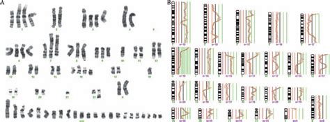 G Banding Karyogram A And CGH Profile B Showing The Same Clonal