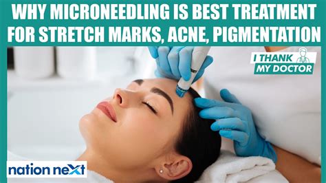 Worlds Best Microneedling Device Maker On Stretch Marks Acne Removal