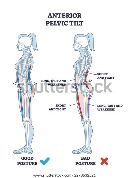 Anterior Pelvic Tilt Apt Pelvis Abnormal Stock Vector (Royalty Free ...