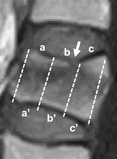 Distribution of endplate injuries. The location of endplate (EP ...