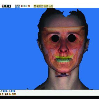 Combination Of CBCT With A 3D Photo Of The Patient With A Scan Of The