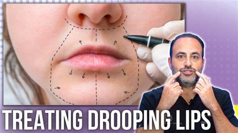 Defying Gravity Treating Drooping Lips With Expert Insights Lesson